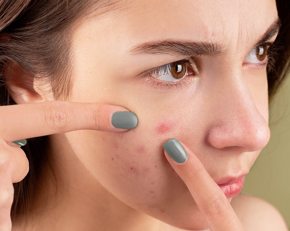 Mituri despre acnee adevărul despre tratamentul pielii